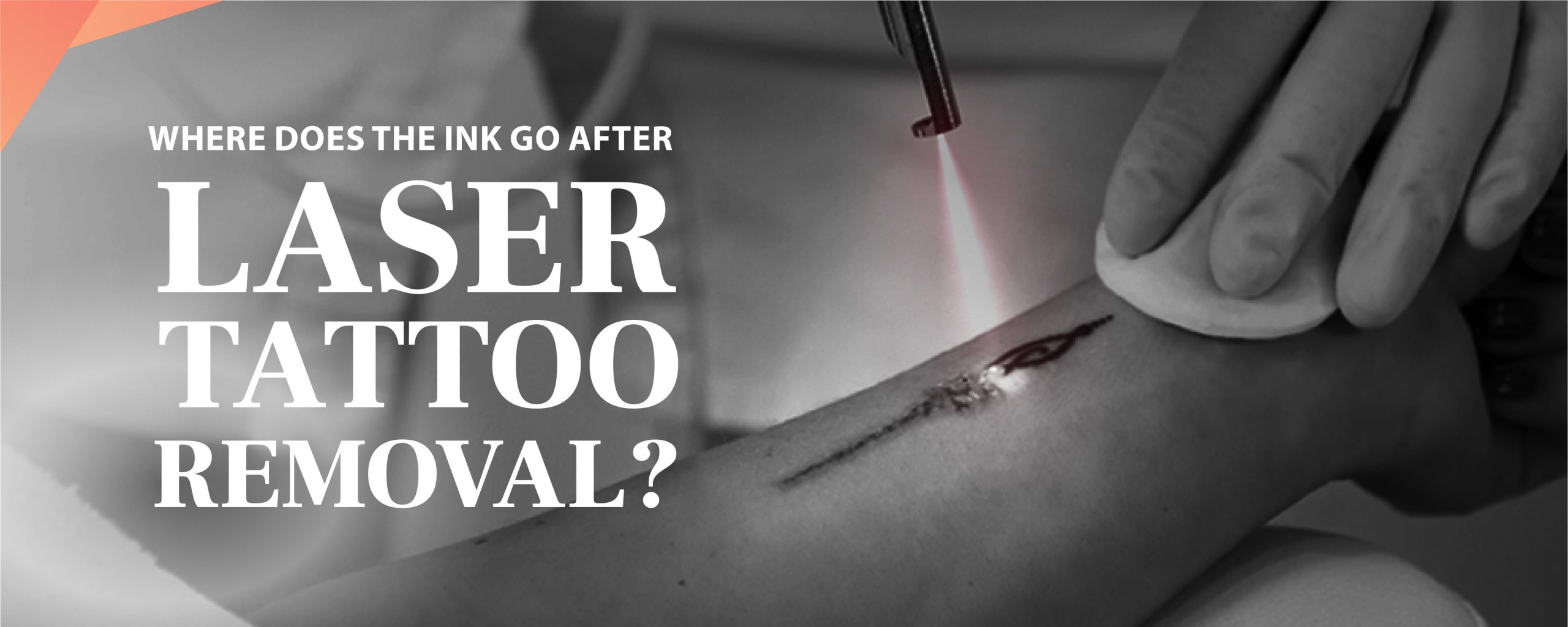 Limited Tattoo Excision | Tattoo Removal Surgery Gainesville Florida