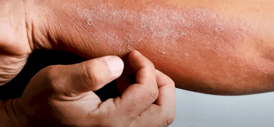Aaj Tak – Lallantop  – Winter में Dry Skin और खुजली से परेशान हैं तो डॉक्टर की ये टिप्स बहुत काम आएंगी |