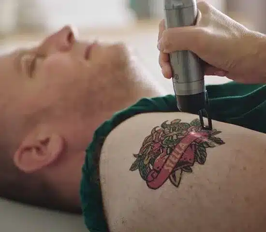 How Are Tattoos Removed?