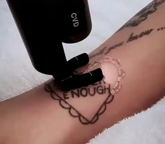 How Does Laser Tattoo Removal Work?