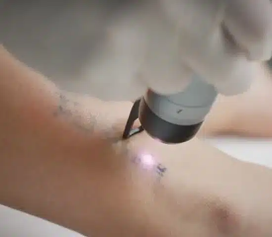 Does Tattoo Removal Work?